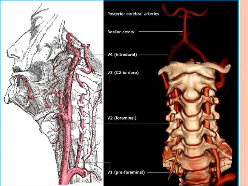 Сегменты v3 v4 позвоночной артерии. Исток позвоночной артерии. Позвоночные артерии v1-v3. V3 сегмент позвоночной артерии.