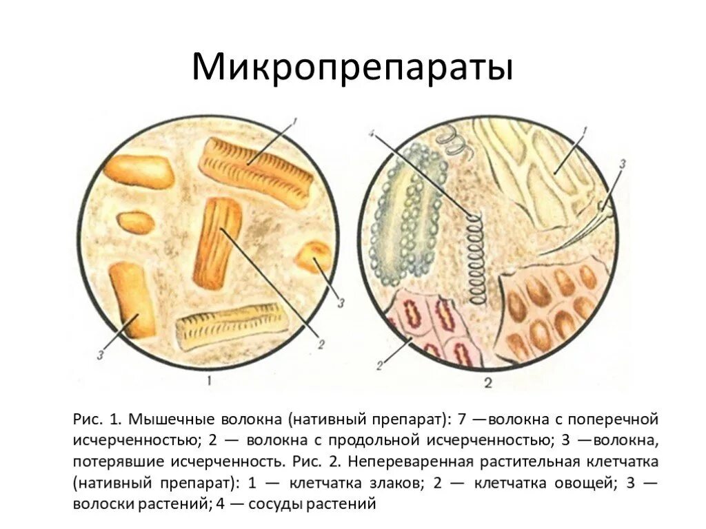 Грибы в копрограмме у взрослого. Микроскопия кала растительная клетчатка непереваримая. Микроскопия кала мышечные волокна. Мышечные волокна в Кале микроскоп. Непереваренные мышечные волокна в Кале.