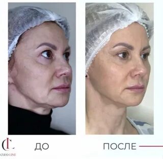 Омоложение кожи матрица горяева лица и тела. Омоложение кожи матрица горяева лица и тела