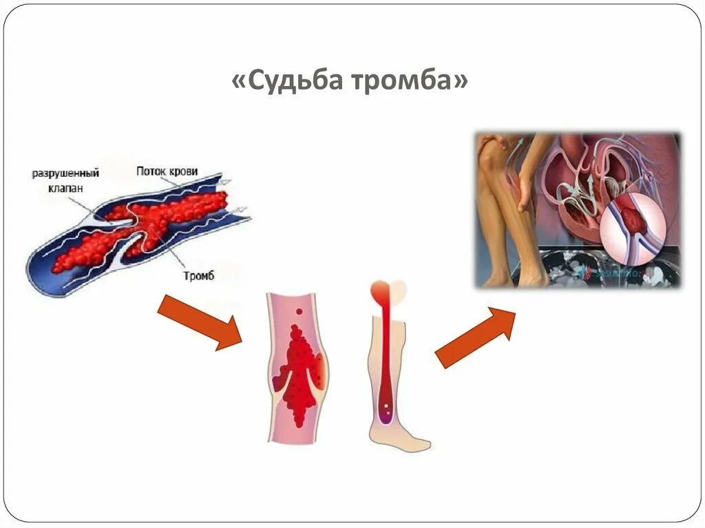 Структура тромба. Клиника тромб