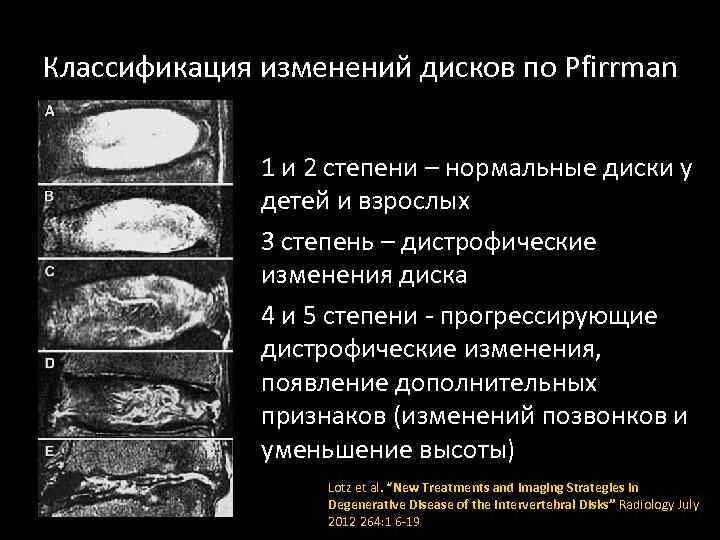 Дистрофические изменения в дисках. Классификация дегенеративных изменений дисков. Дистрофические изменения 2 степени. Степени дегенерации межпозвонковых дисков.