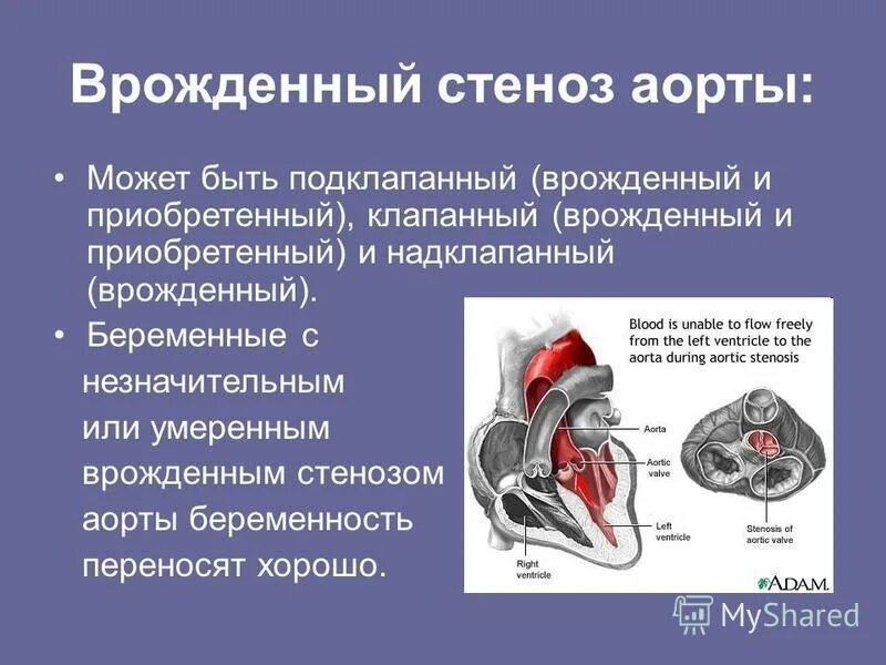 суправульвулярный аортальный стеноз. умеренный стеноз. приобретенные пороки митрального клапана. стеноз аортального клапана степени. аортальный стеноз клинические рекомендации 2022.