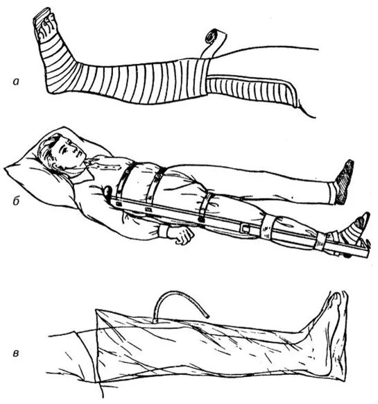 Кровотечение при открытом переломе голени. Транспортная иммобилизация голени шиной Крамера. Транспортная шина Крамера при переломе бедра. Перелом голени транспортная иммобилизация. Перелом бедра иммобилизация.