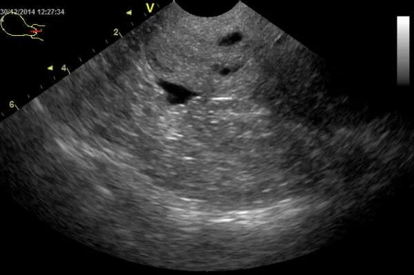 Серозометра что это такое у женщин. Что такое свободная жидкость на узи малого таза. Полип эндометрия серозометра что это такое. Серозометра эндометрия. Узи картина полипа эндометрия.