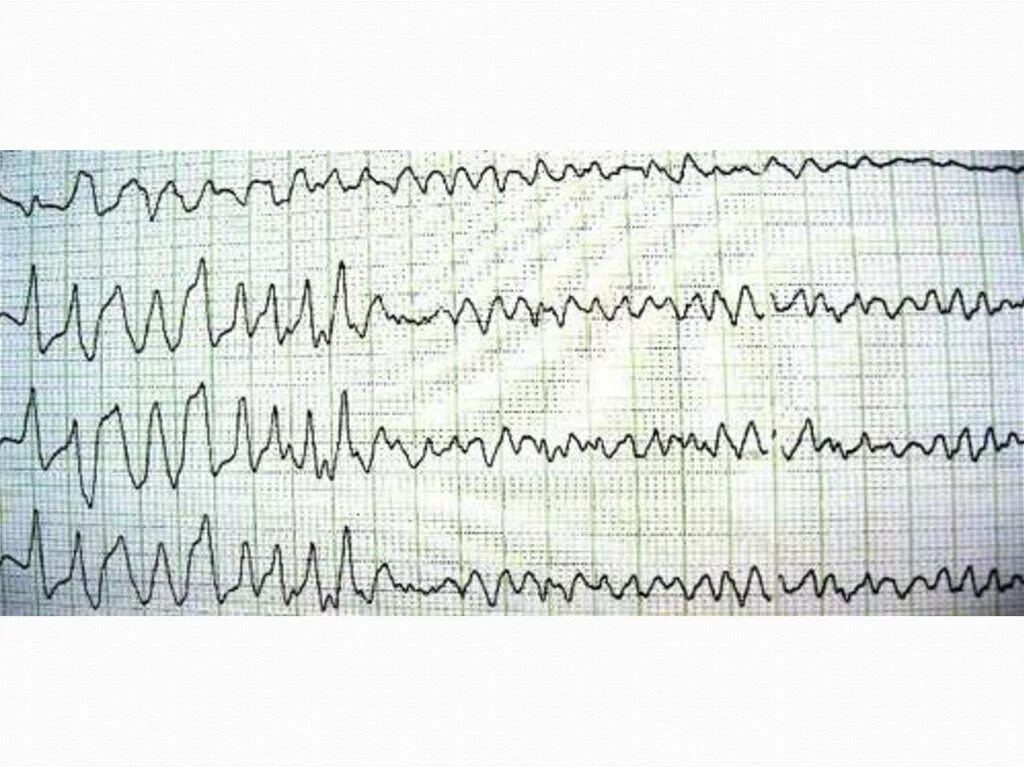 Мелковолновая фибрилляция желудочков ЭКГ. Фибрилляция желудочков на ЭКГ. Крупноволновая фибрилляция желудочков на ЭКГ. Фибрилляция желудочков сердца на ЭКГ.