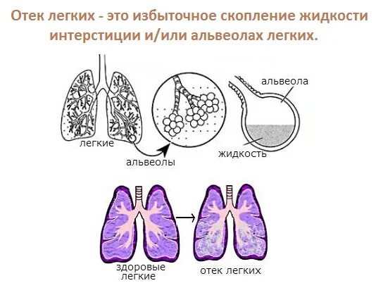 Отек легких симптомы у взрослых. Отек легких при коронавирусе. отёк лёгких при коронавирусе.
