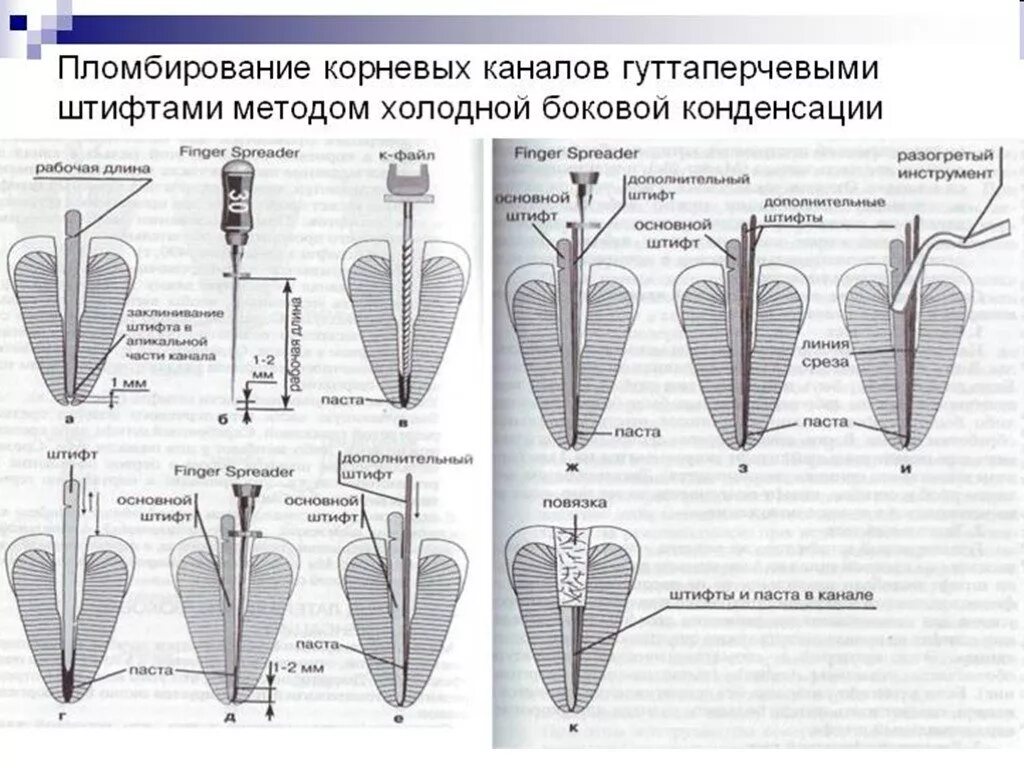 Постоянное пломбирование корневого канала