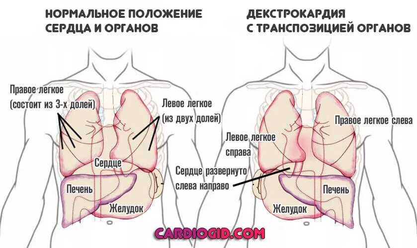 Расположение сердца у человека. Расположение сердца справа. Сердце справа декстрокардия.