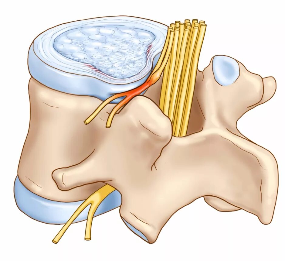 Боли в спине протрузии. Протрузия межпозвонковых дисков. Протрузия дисков позвоночника что это такое. Грыжа межпозвоночного диска и протрузии позвоночника. Грыжа межпозвоночного дис.
