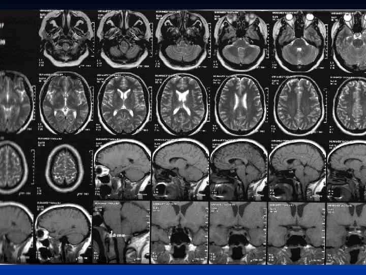 Нейродегенеративное заболевание головного. Нейродегенеративные заболевания головного мозга. Нейродегенеративные заболевания мрт. Нейродегенеративные изменения головного мозга мрт. Нейродегенеративные заболевания головного мозга мрт.