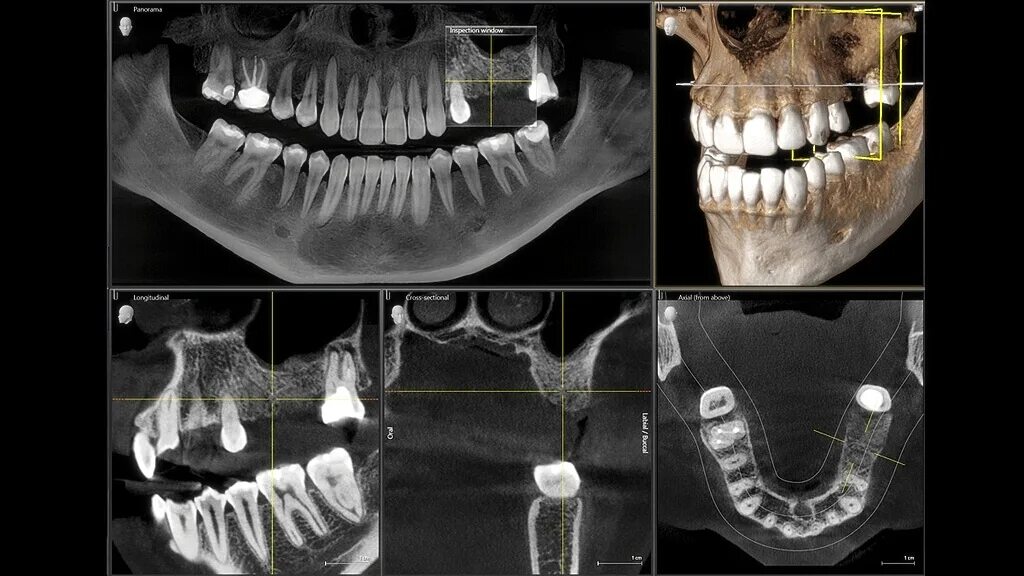 Кт нижней челюсти цена в ульяновске. 3д КЛКТ зубы. Конусная лучевая 3d компьютерная томография. Конусно-лучевую томографию (КЛКТ).