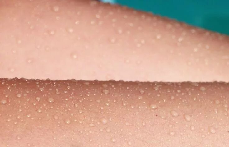 How to Stop Sunburn Peeling - 8 Comforting Tips - AETHEION ® Soothe sunburn, Sun
