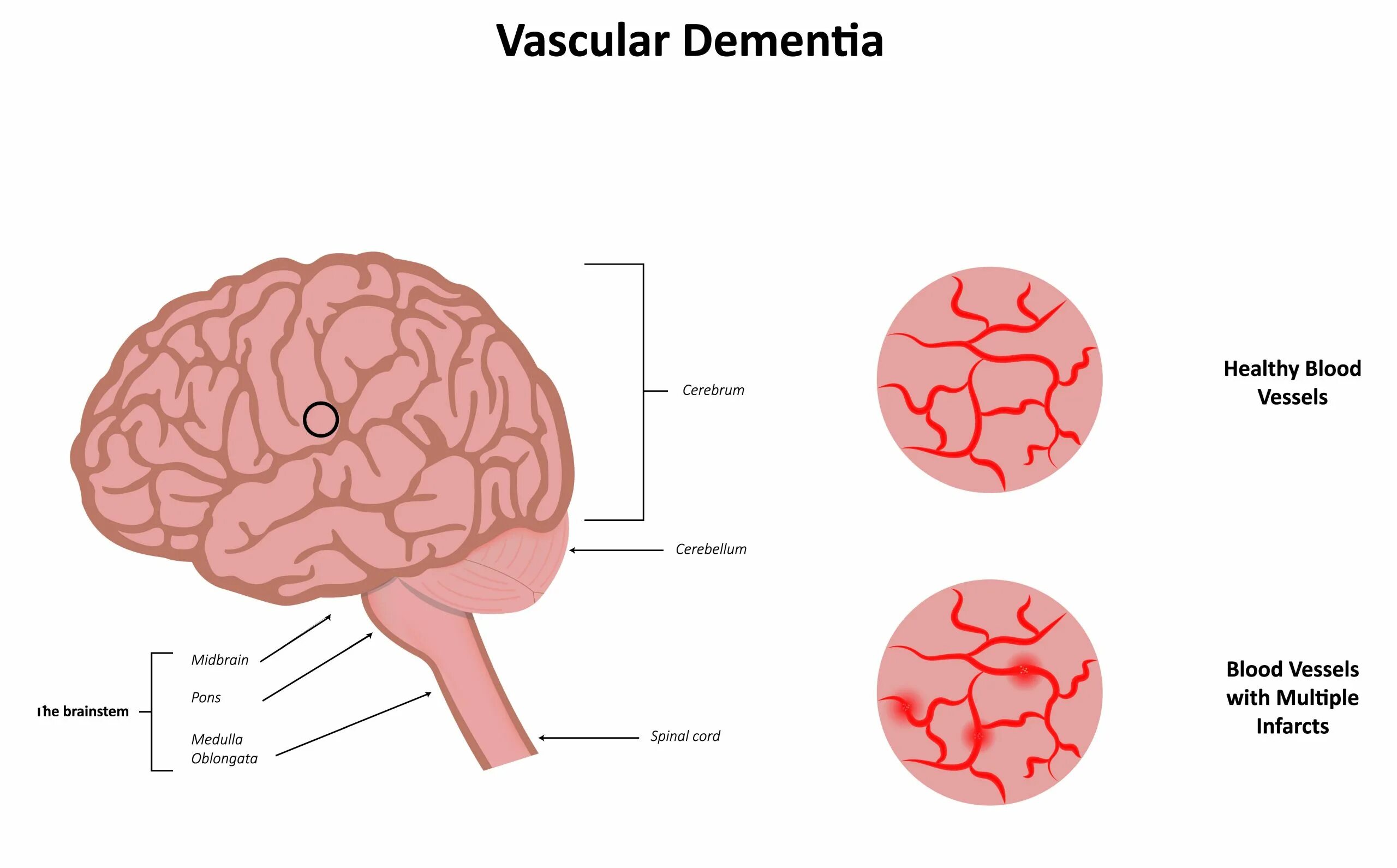 Деменция сосудов головного мозга. Что такое сосудистая деменция головного мозга. Сосудистая деменция мозг. Васкулярная деменция.