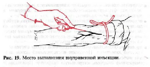 В какую вену колят. Техника введения иглы при внутривенной инъекции алгоритм. внутривенная инъекция в вену локтевого сгиба. место выполнения внутривенной инъекции.
