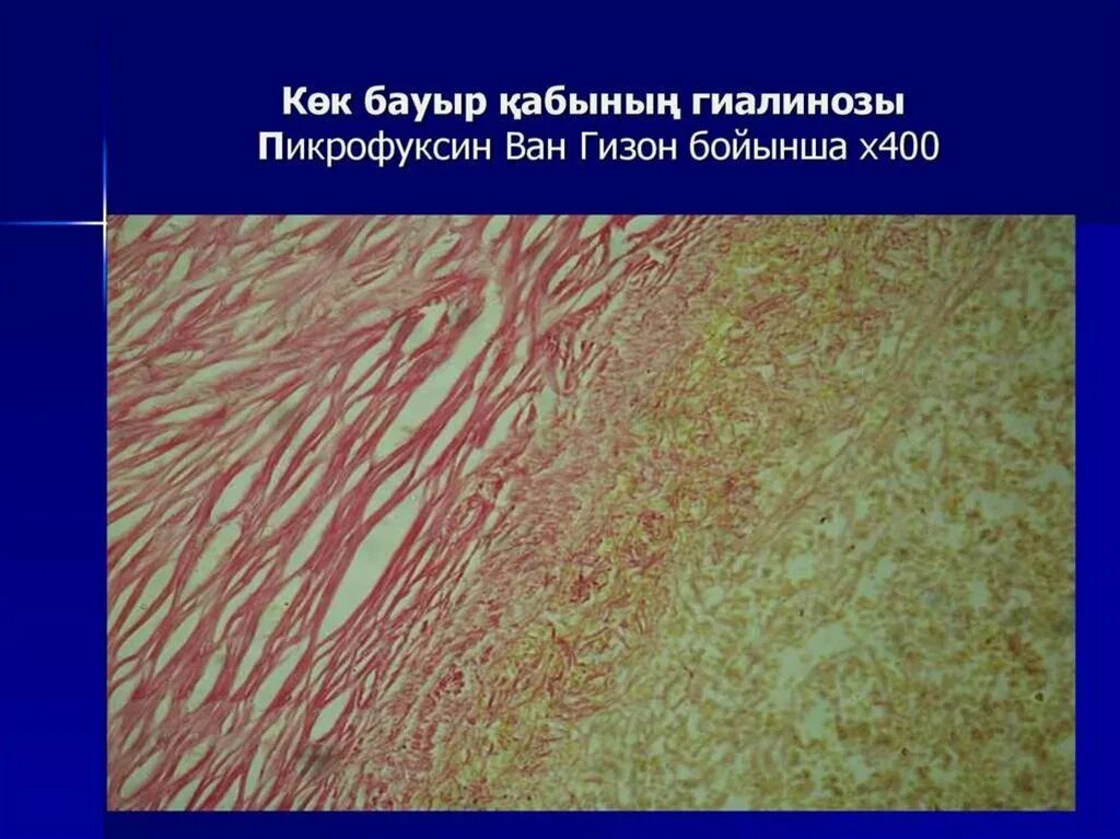 Дистрофия латынь. Пикрофуксином по Ван Гизону. Пикрофуксин соединительная ткань. Дистрофия гиалиноз капсулы селезенки. Амилоидоз селезенки гистология.