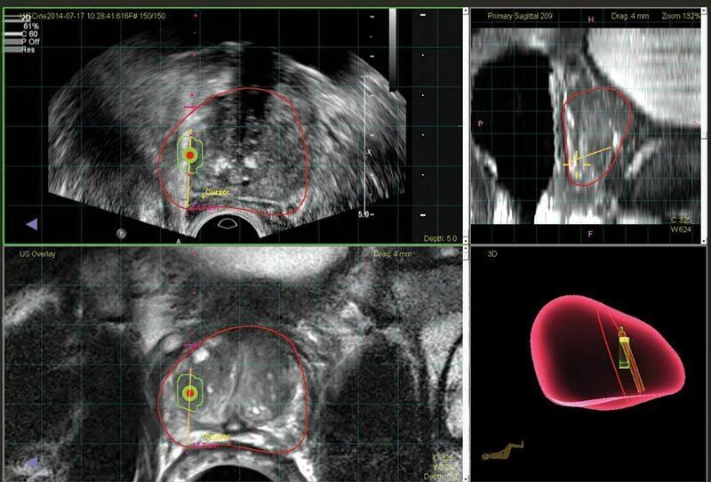 Биопсия рак простаты. Фьюжн биопсия простаты. Трансперинеальная биопсия. Fusion сатурационная биопсия предстательной железы-.