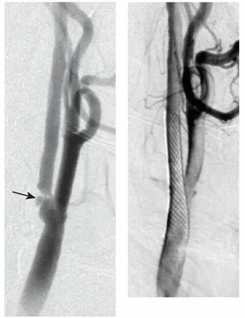 После стентирование самолет. Стентирование сонной артерии. Стентирование сосудов сонной артерии. Стентирование сонной артерии операция. Стентирование брахиоцефальных артерий.