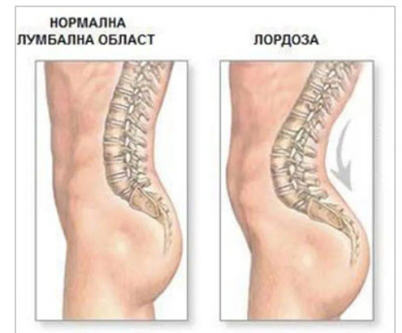 Лордоз позвоночника сглажен. Лордоз шейного отдела отдела. Нормальный лордоз поясничного отдела позвоночника. Гибус грудного отдела позвоночника. Гиперлордоз поясничного отдела.