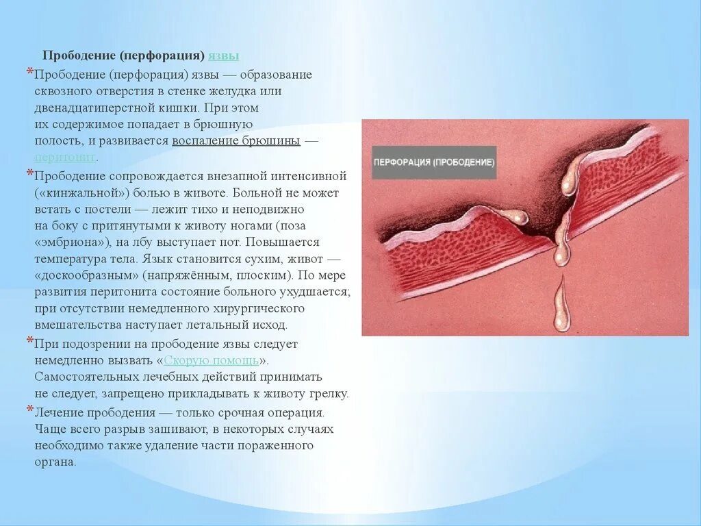 Язвенная болезнь желудка перфорация. Перфоративная язва двенадцатиперстной кишки. Перфоративная язвенная болезнь желудка. Перфорация язвы кишечника. Что такое перфорация кишечника