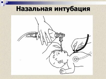 Интубация трахеи дети