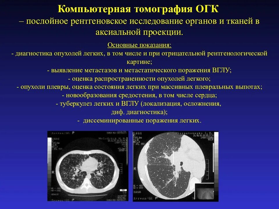 Кт легких. Кт снимки ОГК. Компьютерная томография ОГК. Рентгеновская томография ОГК. Легкие кт 1