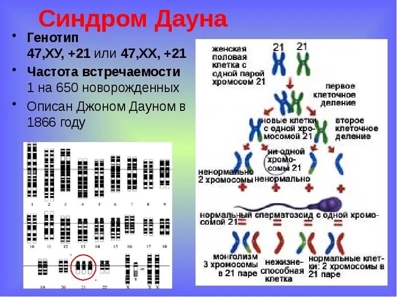 Болезнь Дауна кариотип. Синдром Дауна хромосомная карта. Кариотип человека с синдромом Дауна. Кариотип человека при синдроме Дауна.