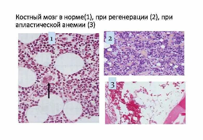 Жировое изменение костного мозга. Срез красного костного мозга гистология рисунок. красный костный мозг препарат гистология. костный мозг в норме гистология. костный мозг при апластической анемии микропрепарат.