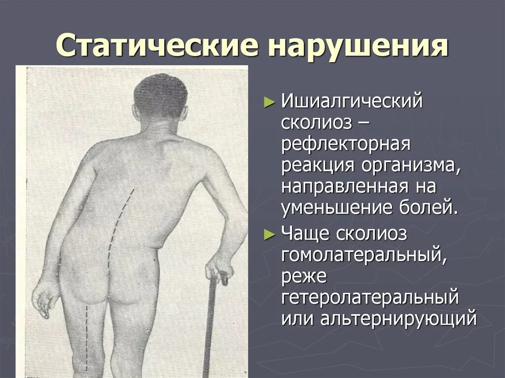 Нарушение статической функции