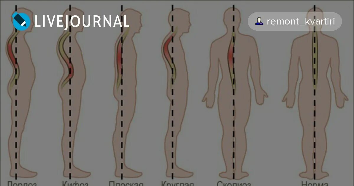 Искривление предметов -позвоночника. Упражнения от искривления члена. Виды искривления члена фото.