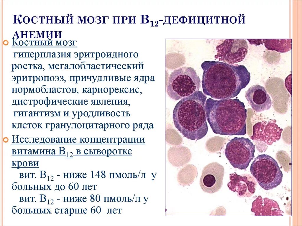 Что будет если есть костный мозг. Изменения костного мозга при б12 дефицитной анемии. Картина костного мозга при в12 дефицитной анемии. Костный мозг при мегалобластной анемии.