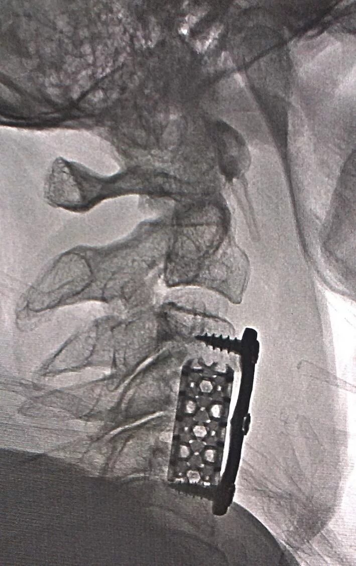 Имплант шейного отдела позвоночника. Корпородез с6-с7 ПДС. Кейдж имплант шейного отдела. Корпородез сетчатым Кейджем. Межтеловой корпородез с5 с7.