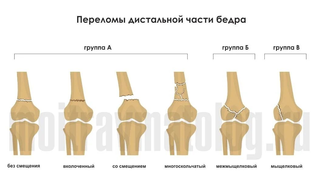 Сколько заживает бедро. Перелом мыщелка бедренной кости классификация. Перелом дистального отдела бедренной кости классификация. Перелом метафиза бедренной кости. Классификация переломов мыщелков бедренной.