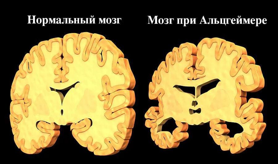 Мозг слабоумие. Болезнь Альцгеймера мозг. Мозг больного Альцгеймером. Мозг Альцгеймера и нормального человека.