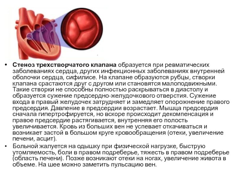 Сердечный стеноз. Стеноз и недостаточность трикуспидального клапана. Стеноз трикуспидального клапана гемодинамика. Стеноз трехстворчатого клапана. Сужение отверстия трехстворчатого клапана.