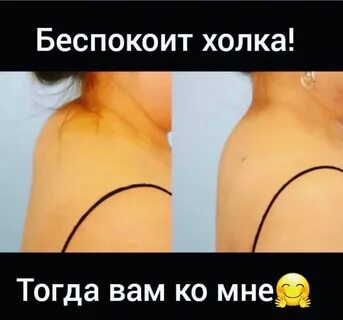 Горб шейного отдела