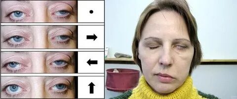 Птоз верхнего века форум