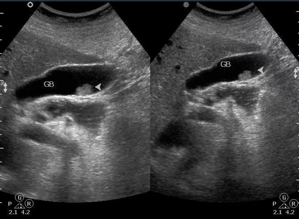 УЗИ желчного пузыря с ЦДК. Опухоль желчного пузыря на УЗИ. УЗИ ОБП. УЗИ ОБП И почек.