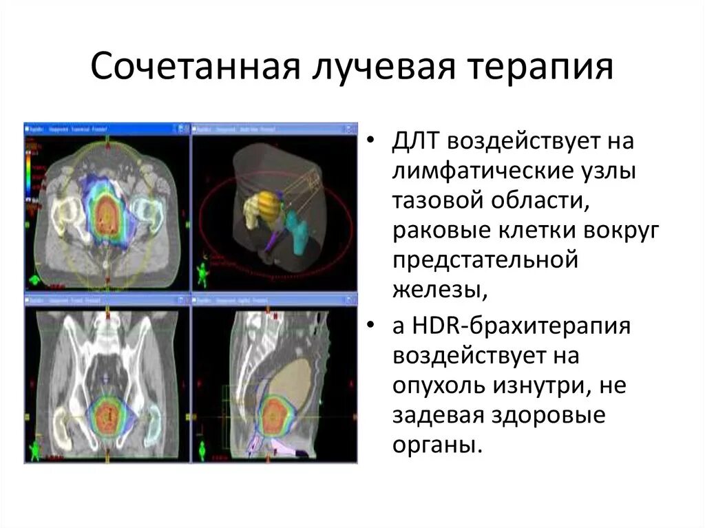 Лучевая терапия при онкологии предстательной железы. Методы лучевой терапии сочетанные. Сочетанный метод лучевой терапии это:. Дистанционная лучевая терапия.