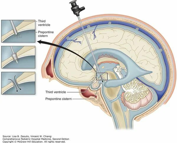 Операции при гидроцефалии. Шунтирование ликвора головного мозга. Шунт при гидроцефалии схема. Наружный вентрикулярный дренаж при гидроцефалии. Эндоскопическая анатомия желудочков мозга.