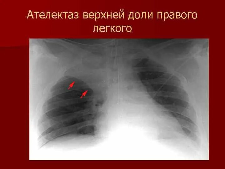 Ателектаз верхней доли рентгенограмма. Ателектаз нижней доли рентген. Рентгенография ателектаза легкого. Ателектаз средней доли рентген. Ателектаз нижнего легкого