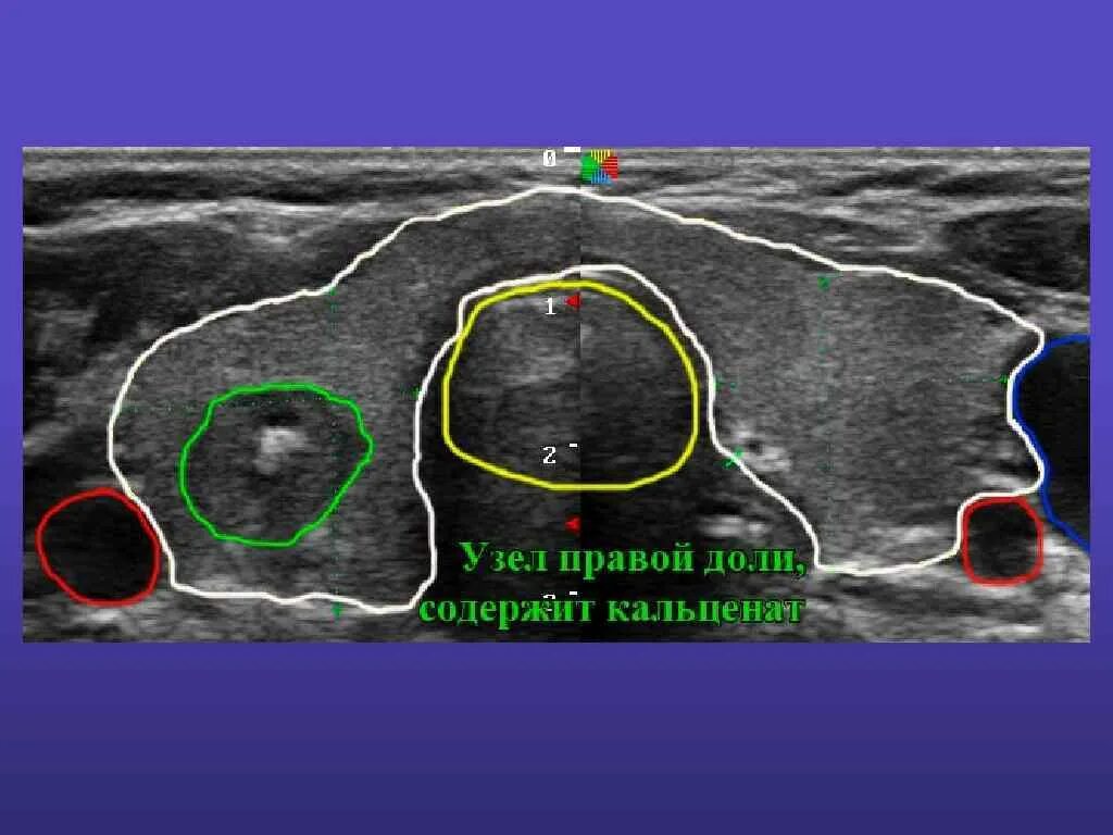 Кальцинат в правой доле. Кальцинированный узел щитовидной железы УЗИ. Узел в щитовидной железе на УЗИ. Микрокальцинаты щитовидной железы. Узел перешейка щитовидной железы УЗИ.