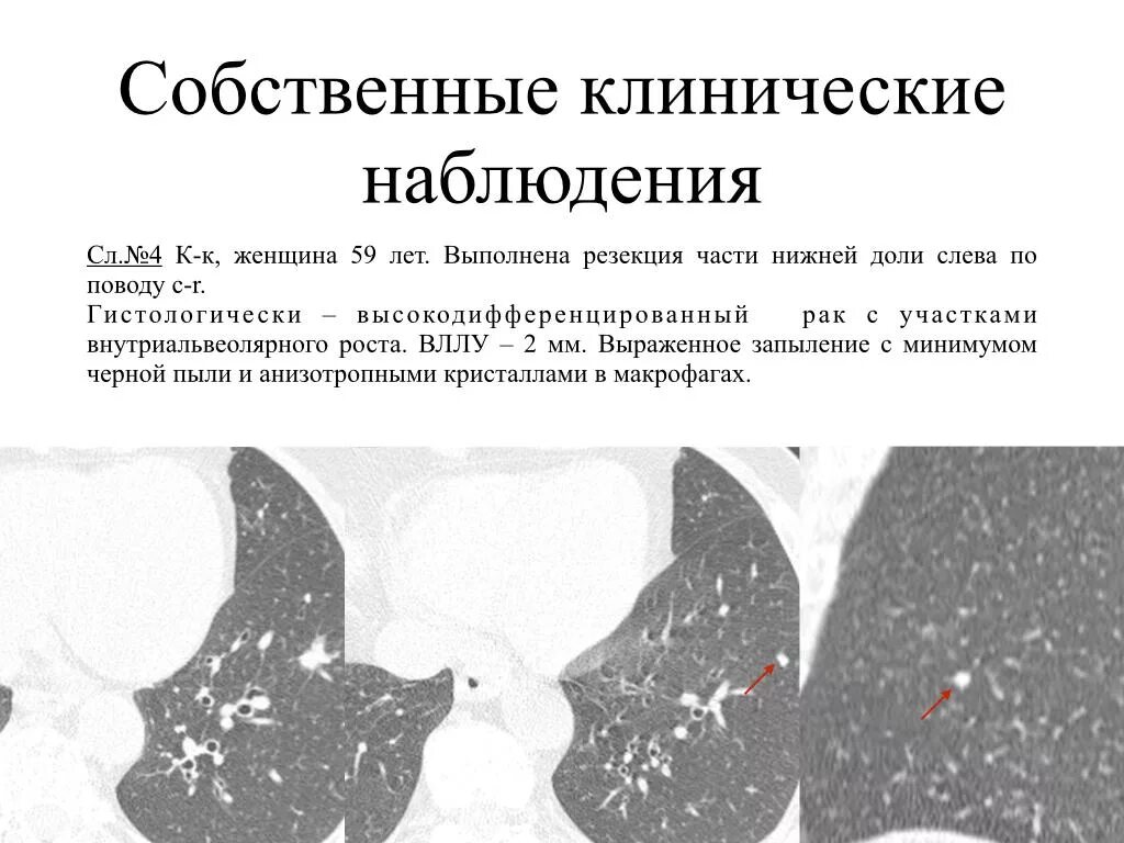 Увеличение лимфоузлов в легких причины. Узлы легких кт Внутрилегочные лимфоузлы. Лимфатические узлы в легких на кт. Внутрилегочные лимфатические узлы на кт. Лимфатические узлы грудной клетки кт.