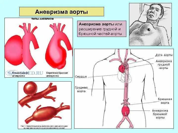 Аневризма сердца что это такое симптомы. Клинические симптомы аневризма аорты. 171.4 Аневризма брюшной аорты. Аневризма торакального отдела аорты. Аневризма грудного отдела аорты симптомы разрыв.