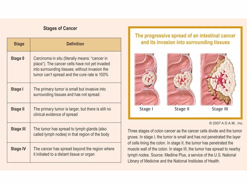 Stages of cancer