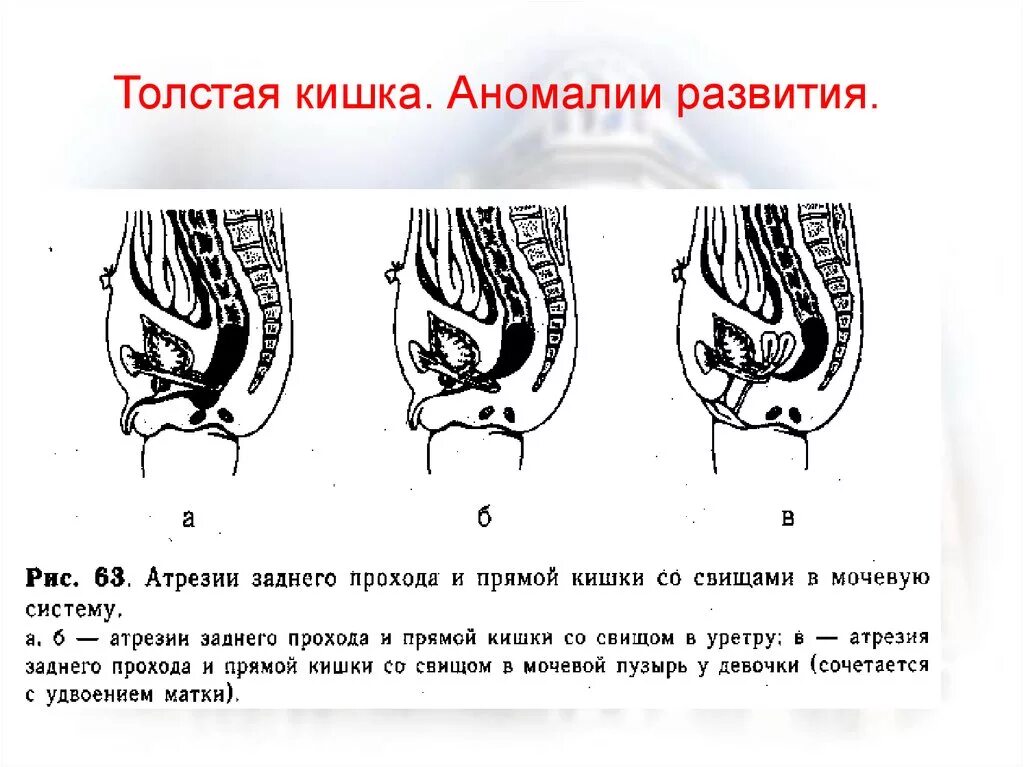 Матка в заднем проходе