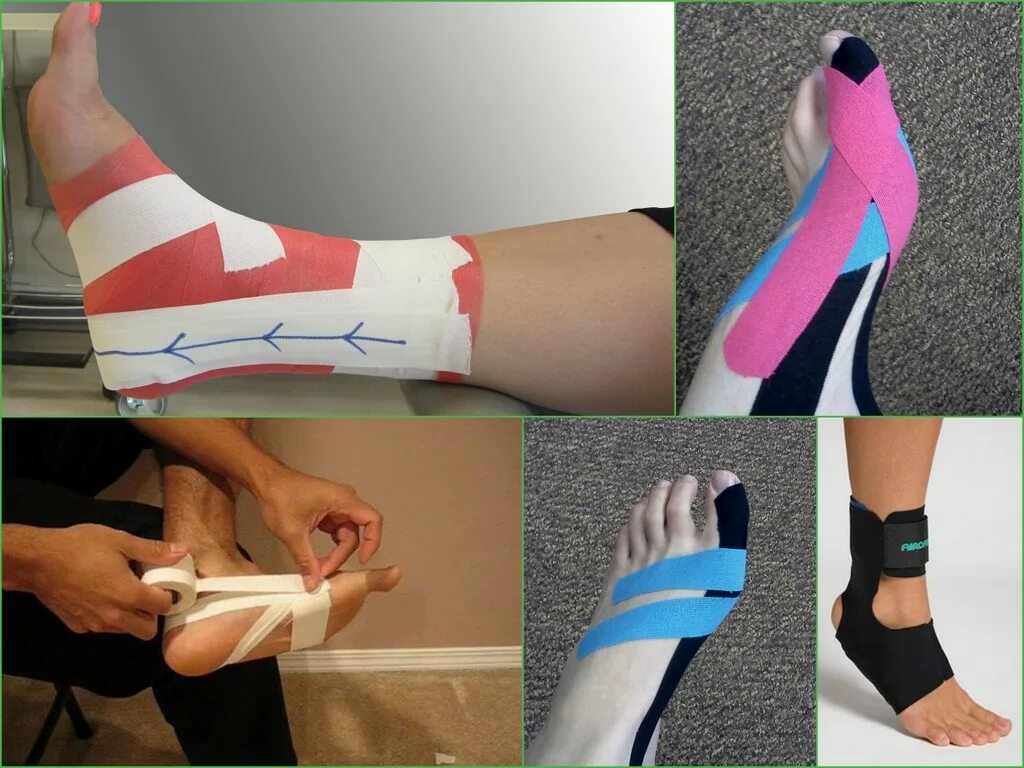 тейпирование вальгусной стопы. кинезио тейпирование стопы. тейпироааниестопы схема. тейпирование при плоскостопии. тейпирование при косолапии у ребенка.