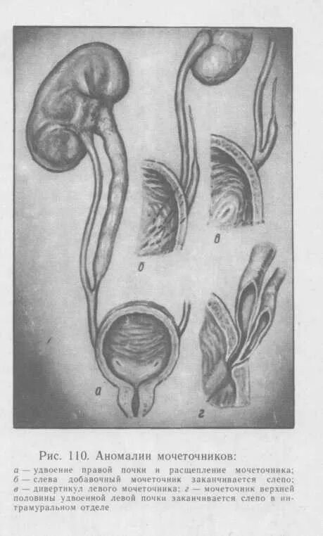 Удвоение мочеточника. Врожденные аномалии мочеточников классификация. Аномалии формы мочеточника. Врожденная аномалия развития мочеточников. Пороки развития мочеточника.