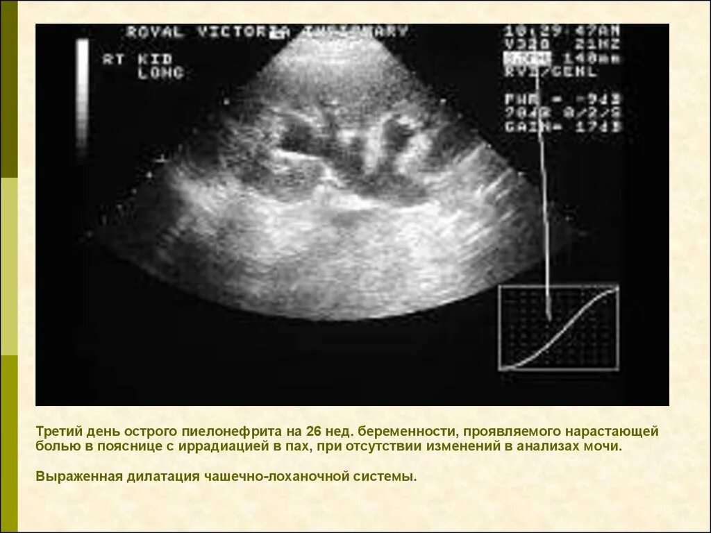 Что значит члс. Расширение чашечно-лоханочной системы на УЗИ. Признаки расширения лоханочно-чашечной системе на УЗИ. Расширение лоханочной системы почек УЗИ. Расширение чашечно-лоханочной системы почек на УЗИ.