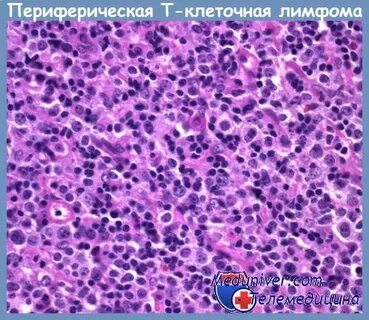 Лечение т клеточных лимфом