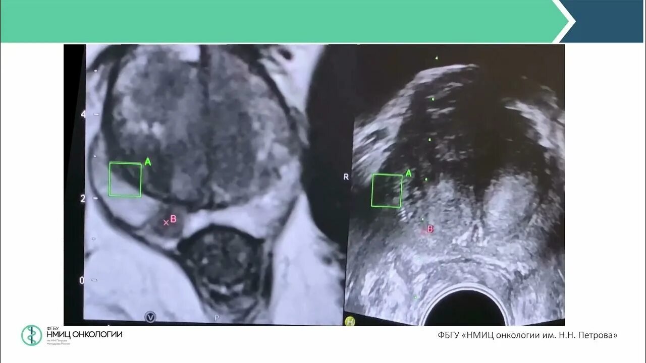Фьюжн биопсия предстательной железы мрт. Мультипараметрическая мрт предстательной железы. Сатурационная биопсия простаты.
